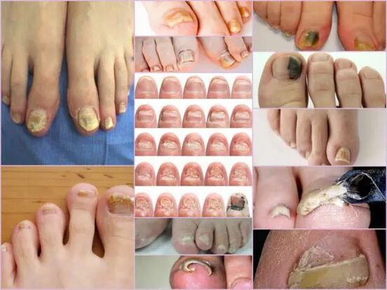 Varietetet e onychomycosis